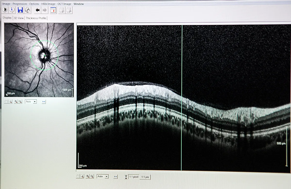 L’angiographie à la fluorescéine