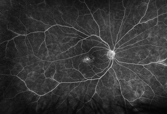 L’angiographie à la fluorescéine