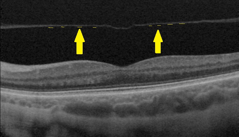 d&eacute;collement post&eacute;rieur du vitr&eacute;, image OCT