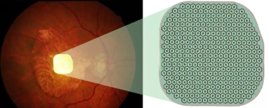 implant photovolta&iuml;que positionn&eacute; au niveau de la macula pour les patients avec DMLA 