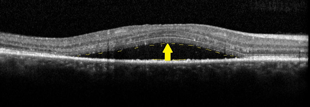 chorio-r&eacute;tinopathie s&eacute;reuse vue OCT