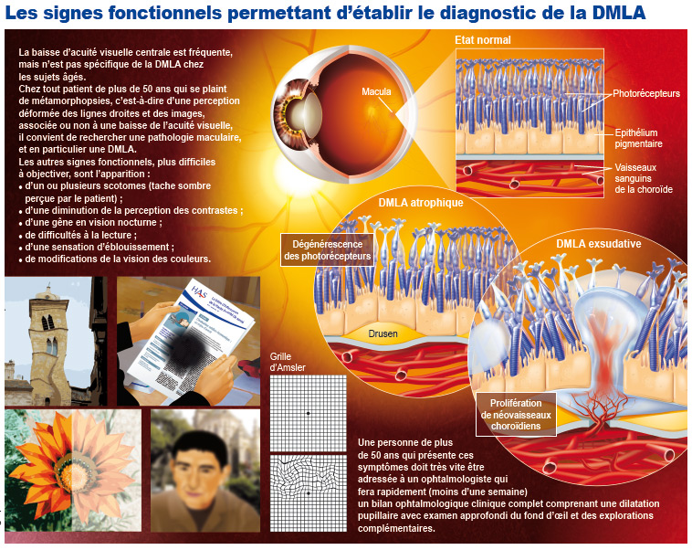 Les signes fonctionnels permettant d'établir le diagnostic de la DMLA - Rétine Nantes