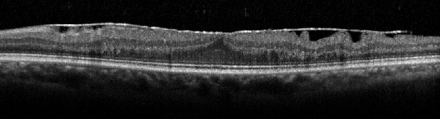 OCT mettant en évidence une membrane anormale développée à la surface de la rétine