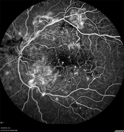 Rétinopathie diabètique proliférante