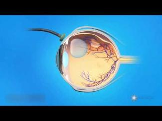 Opération du décollement de la rétine par vitrectomie