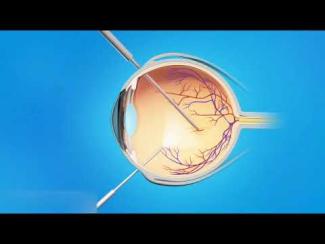 Opération de membrane épirétinienne par vitrectomie - D&eacute;roulement, convalescence et r&eacute;cup&eacute;ration