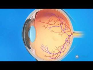 Occlusion de la veine centrale de la r&eacute;tine - OVCR - Thrombose d'une veine r&eacute;tinienne