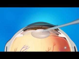 Opération de la cataracte