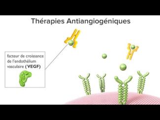 Les th&eacute;rapies antiangiog&eacute;niques pour la DMLA humide : Animation