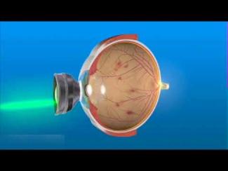 Laser Argon de la r&eacute;tine - Pan photo coagulation r&eacute;tinienne, d&eacute;chirure