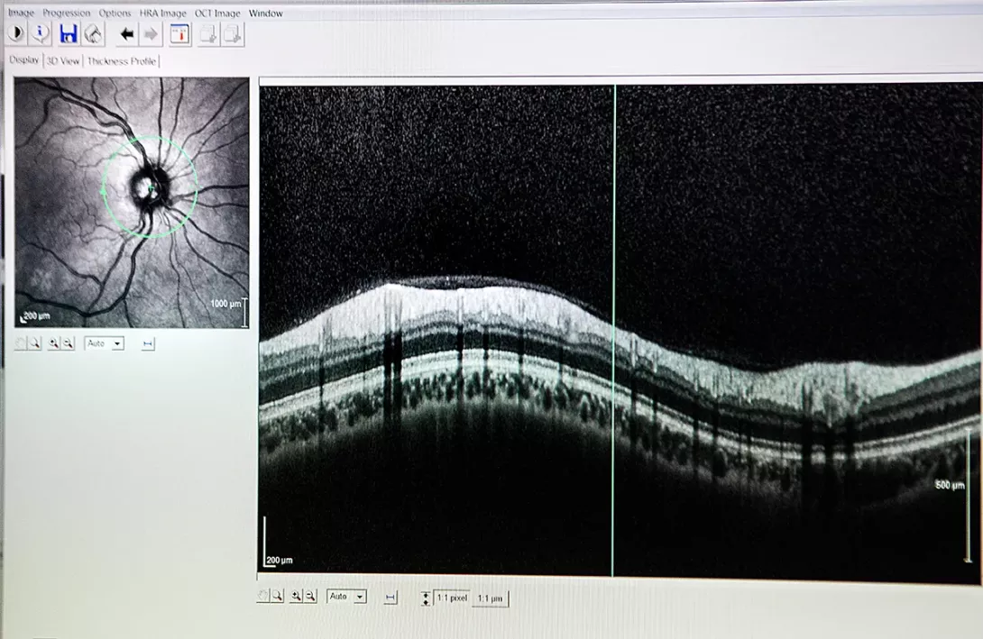 L’angiographie à la fluorescéine
