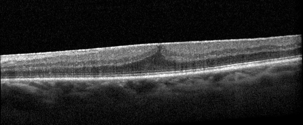 Membrane épi-maculaire