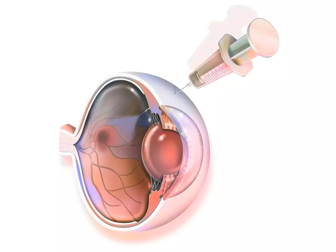 Injections intra-vitr&eacute;ennes &agrave; l'Institut de la r&eacute;tine de Nantes
