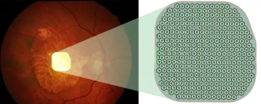 implant photovolta&iuml;que positionn&eacute; au niveau de la macula pour les patients avec DMLA 